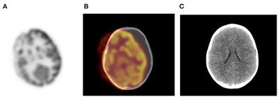 Normal Variants and Pitfalls of 18F-FDG PET/CT Imaging in Pediatric Oncology